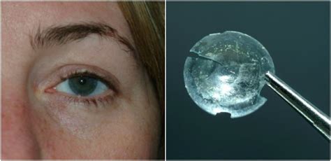 A Woman Had A Contact Lens Stuck In Her Eye For 28 Years And Did Not