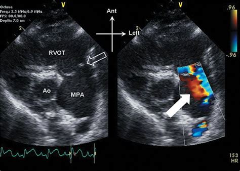 Abnormalities Of Right Ventricular Outflow Thoracic Key