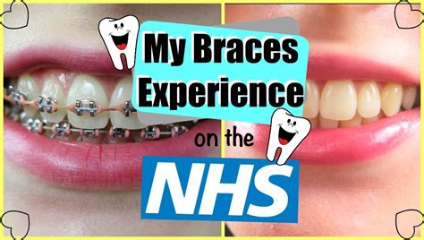 My Braces Experience On The Nhs Youtube