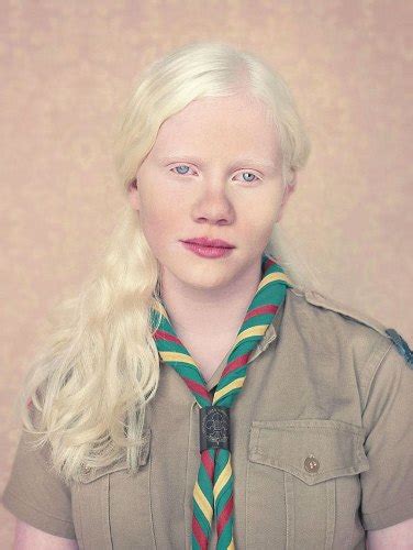 10 Interesting Albinism Facts My Interesting Facts