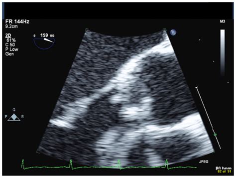 Aerococcus Urinae A Rare Cause For Multi Valve Endocarditis