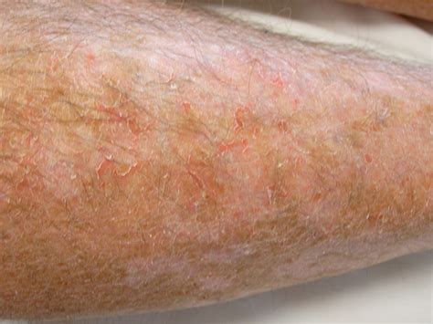 Preventing And Managing Dry Skin In Older People Bpj63 September 2014