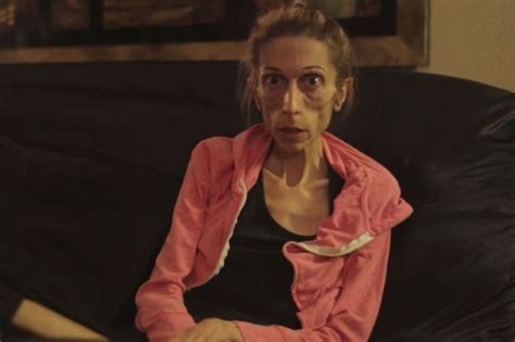 Anorexic Woman At Risk Of Dying After Dropping To 5st Looks Incredible