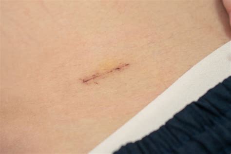 Appendectomy Scar Stock Photos Pictures And Royalty Free Images Istock