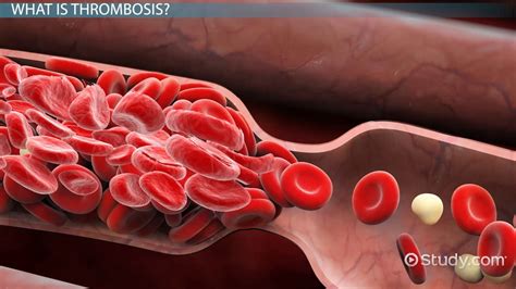 What Is Thrombosis Definition Symptoms And Treatment Video And Lesson