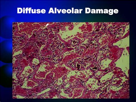 PPT DIAGNOSIS IN DIFFUSE ALVEOLAR HEMORRHAGES PowerPoint Presentation