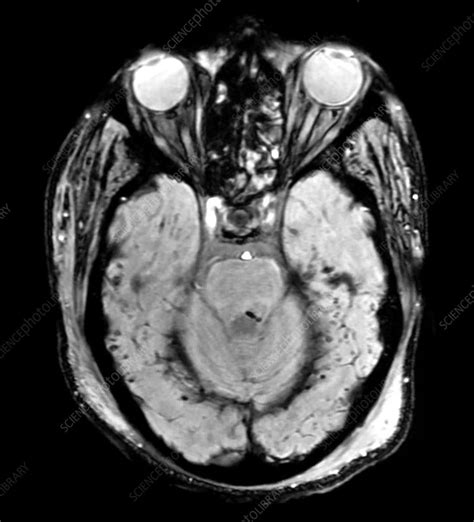 Traumatic Brain Injury Mri Stock Image C0432966 Science Photo