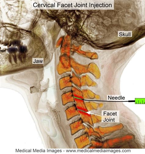 Pin By Tiffany Foggy On My Best Life Cervical Spondylosis Spine