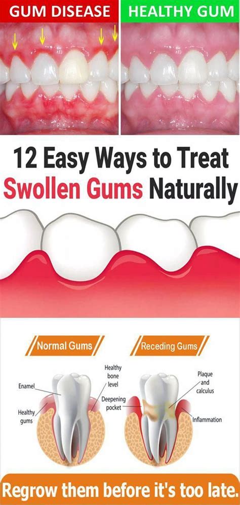 In Medical Terminology Swollen Gums Are Known As Gingival Swelling Or