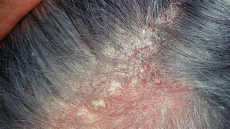 Dandruff Red Patches On Scalp Toxoplasmosis