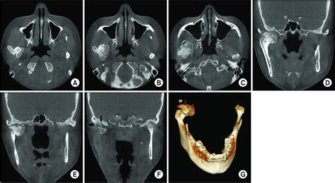 Cone Beam Computed Tomography Ct A C Axial Scans D F Coronal