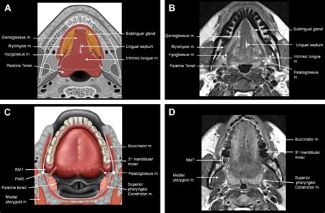Pitfalls In The Staging Of Cancer Of Oral Cavity Cancer Neuroimaging