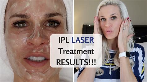 Ipl Laser Treatment Results ⭐ Photofacial And Sublative Form Med Spa