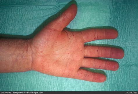 Stock Image Symptoms Of Crest Syndrome A Type Of Scleroderma Of The