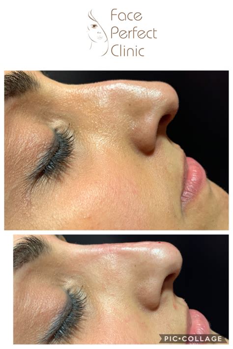 Non Surgical Rhinoplasty Liquid Nose Job Face Perfect Clinic Leeds