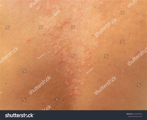 Pityriasis Versicolor Tinea Versicolor Skin Disease Stockfoto