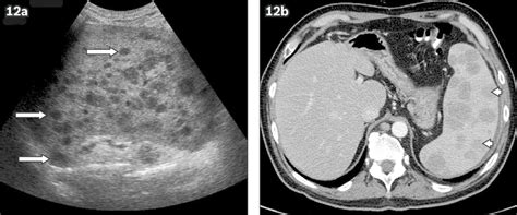 Multifocal Splenic Involvement In Lymphoma A Us Image Shows Several