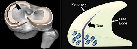 Mr Imagingbased Diagnosis And Classification Of Meniscal Tears