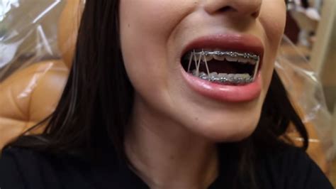 Braces Girlswithbraces Metalbraces Elastics Powerchain Braces Rubber Bands Orthodontics