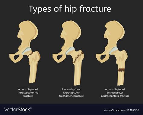 Types Of Hip Fracture Royalty Free Vector Image
