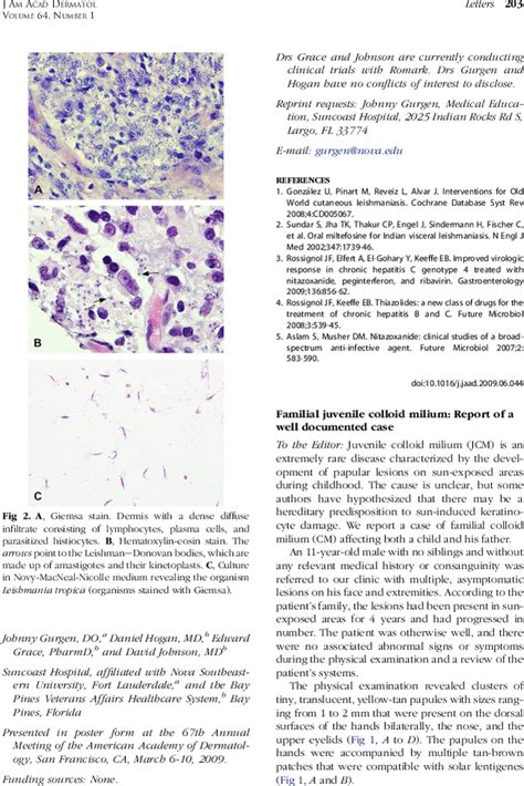 Familial Juvenile Colloid Milium Report Of A Well Documented Case