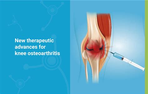 New Therapeutic Advances For Knee Osteoarthritis Arthrosis Clinic
