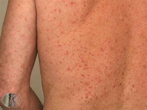 What Does Scabies Look Like Scabies Home Remedies