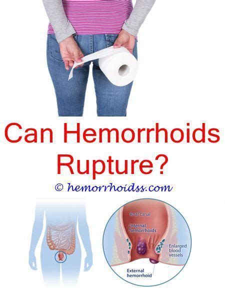 Pin On Treating Hemorrhoids