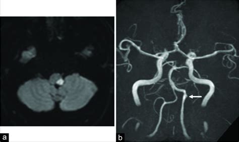 A Case Of Unilateral Vertebral Artery Dissection Progressing In A Short Time Period To Bilateral