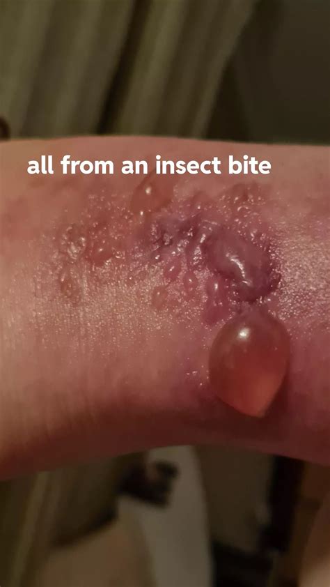 Blistering Bite From A Small Garden Flea I Ended Up In A E On Iv Antibiotics Last Time Nudes