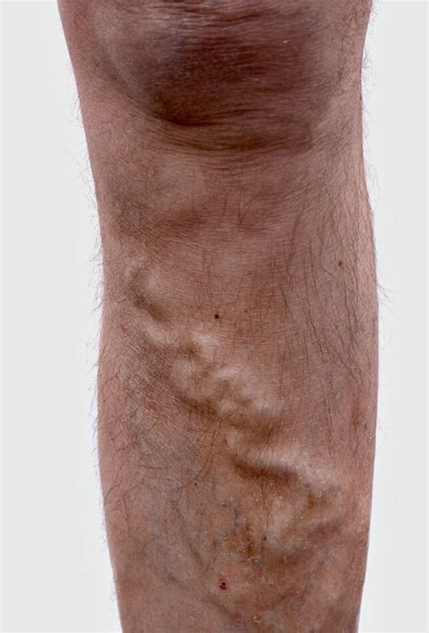 Recurrent Varicose Veins Vein Clinic Dublin Drogheda Cavan