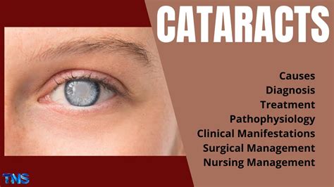 Cataracts Risk Factors Pathophysiology Nursing Management
