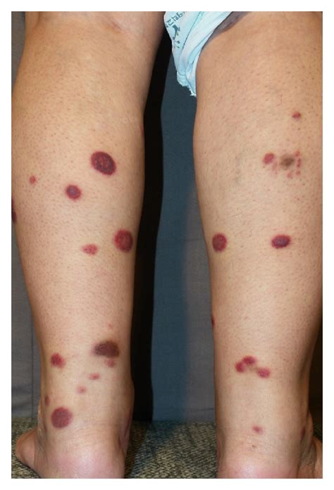 Cutaneous T Cell Lymphoma In Asians
