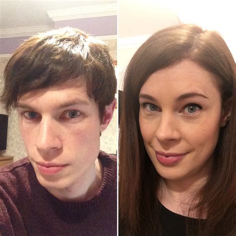 34 The Difference 3 Years Makes 25 Years Hrt 17 Months Post Ffs