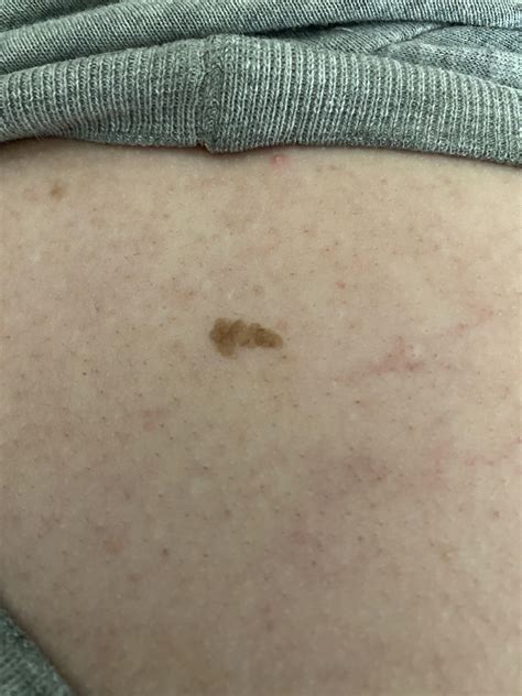 Resulting Scar From Having A 25mm Nodular Ulcerated Melanoma Removed