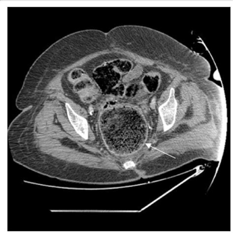 Abdominal Ct Scan Showing Fecal Impaction In Dilated Ascending And