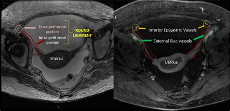 Figure 1 From Deep Endometriosis Dont Forget About Round Ligaments Mri Features Clinical And
