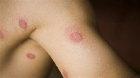 How You Can Spot The Differences Between Ringworm And Eczema Goodrx