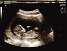 Did You Know Sonograms Have Been Around for Over 60 Years? - sigfox.us ...
