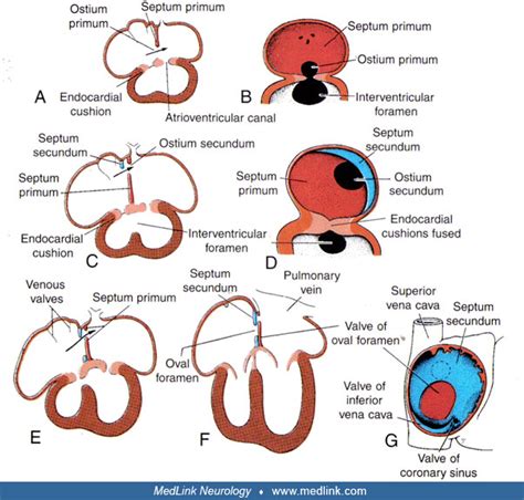 Patent Foramen Ovale Pfo Medlink Neurology