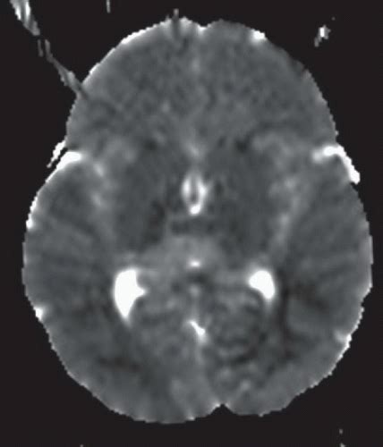 Hypoxic Ischemic Brain Injury Radiology Key
