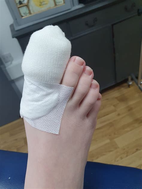 What Happens During Toenail Surgery West Berkshire Foot Clinic