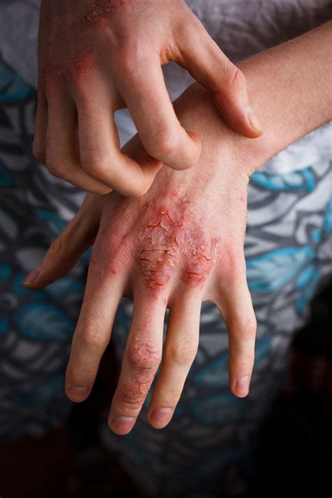 Eczema Causes Symptoms Treatments How To Get Rid Of Eczema Ph