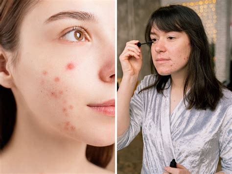 Woke Up With A Face Full Of Acne Here Are The Possible Reasons
