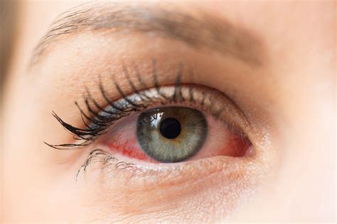 Viral Conjunctivitis Or Red Eye Clinica London