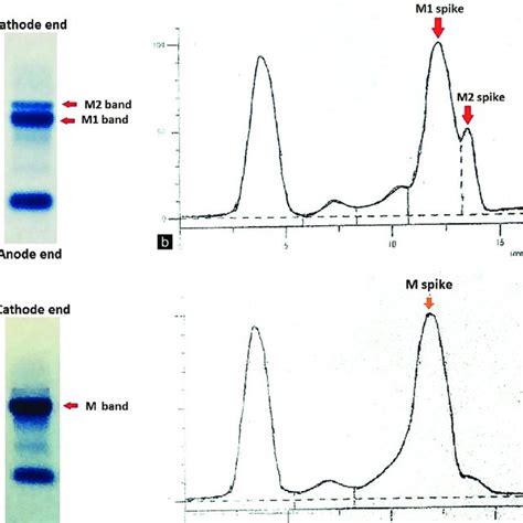 Serum Protein Electrophoresis A Gel Picture Showing Two Distinct
