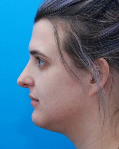 Rhinoplasty Nose Surgery Beaty Facial Plastic Surgery