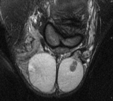 Testicular Cancer Radiology Reference Article Radiopaedia Org