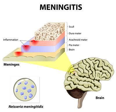 Cu Les Son Los S Ntomas De La Meningitis Viral