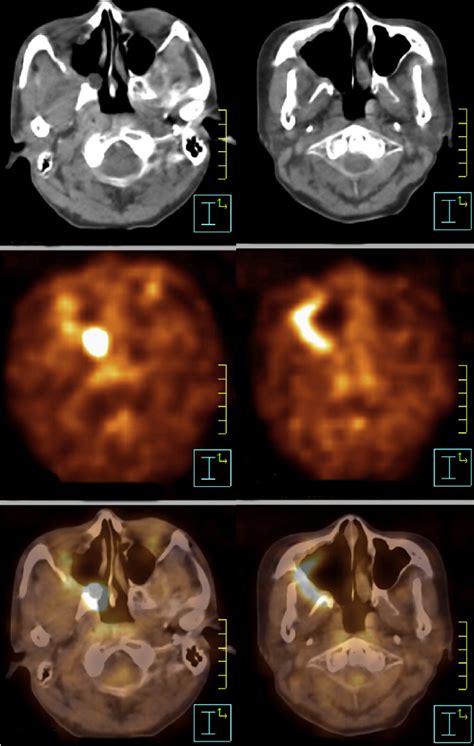 Visual Assessment Of F 18 Fdg Petct When Focal F 18 Fdg Uptake In